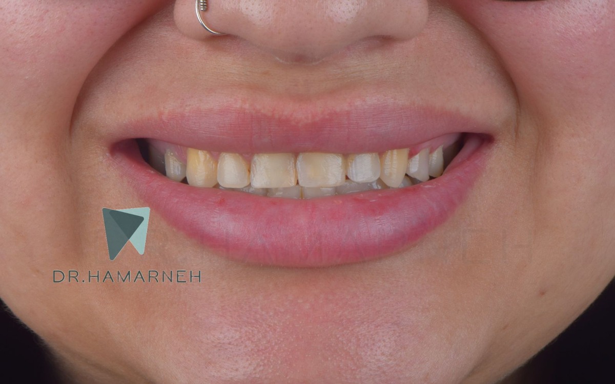 Veneers case before treatment