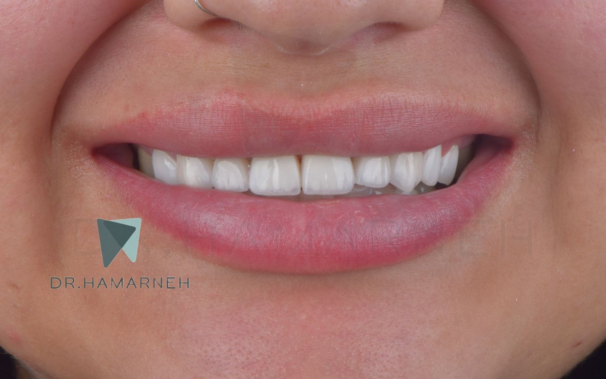 Veneers case after treatment