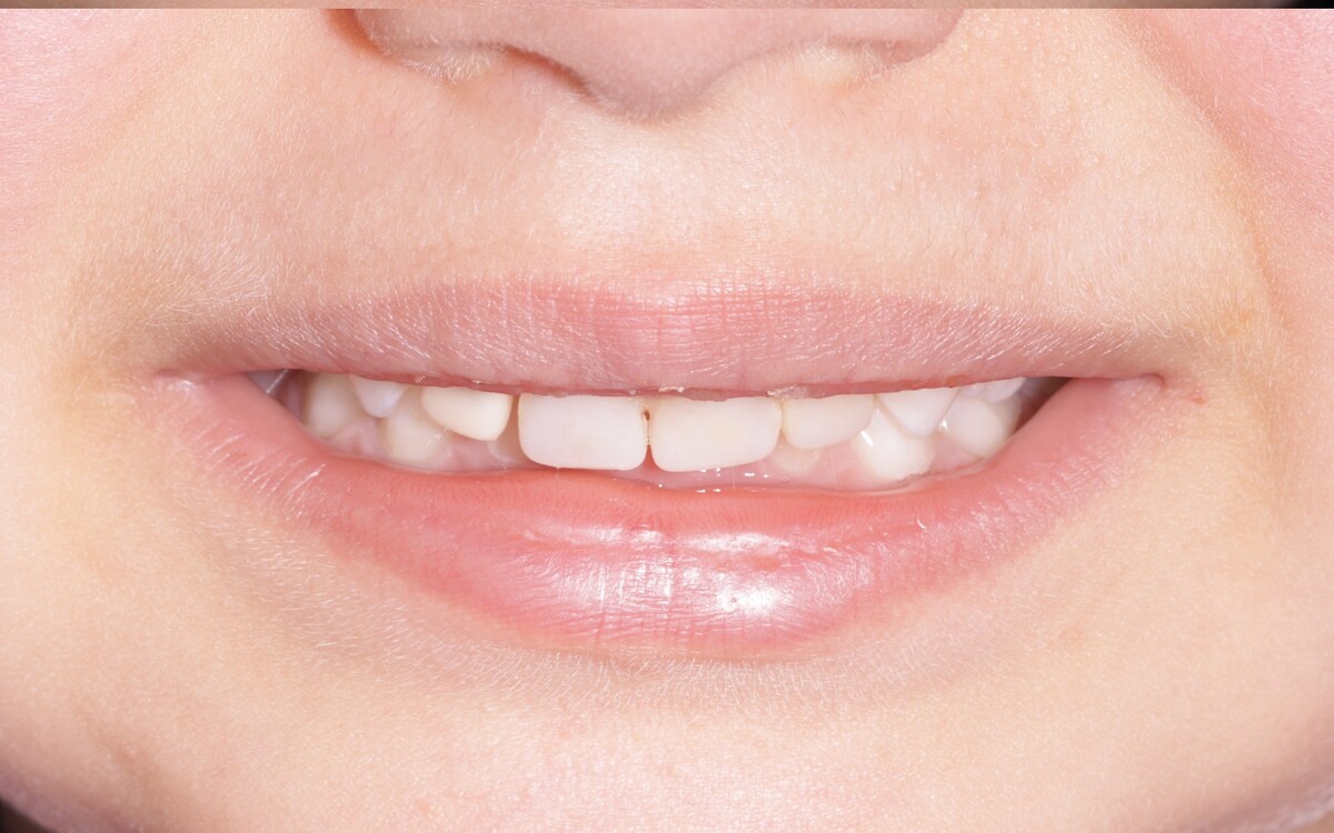 Pediatric dental case after treatment
