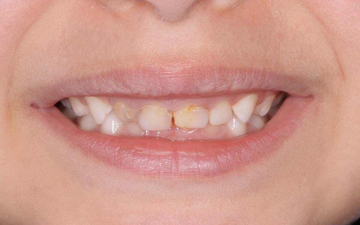Pediatric dental case before treatment