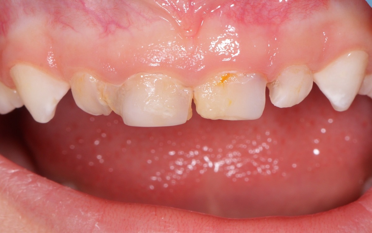 Pediatric dental case before treatment
