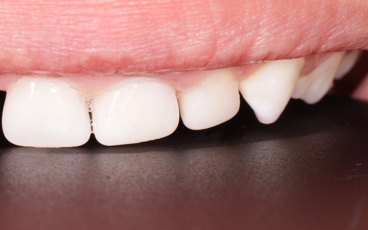 Pediatric dental case after treatment