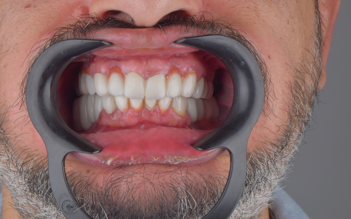 Dental implant case after treatment