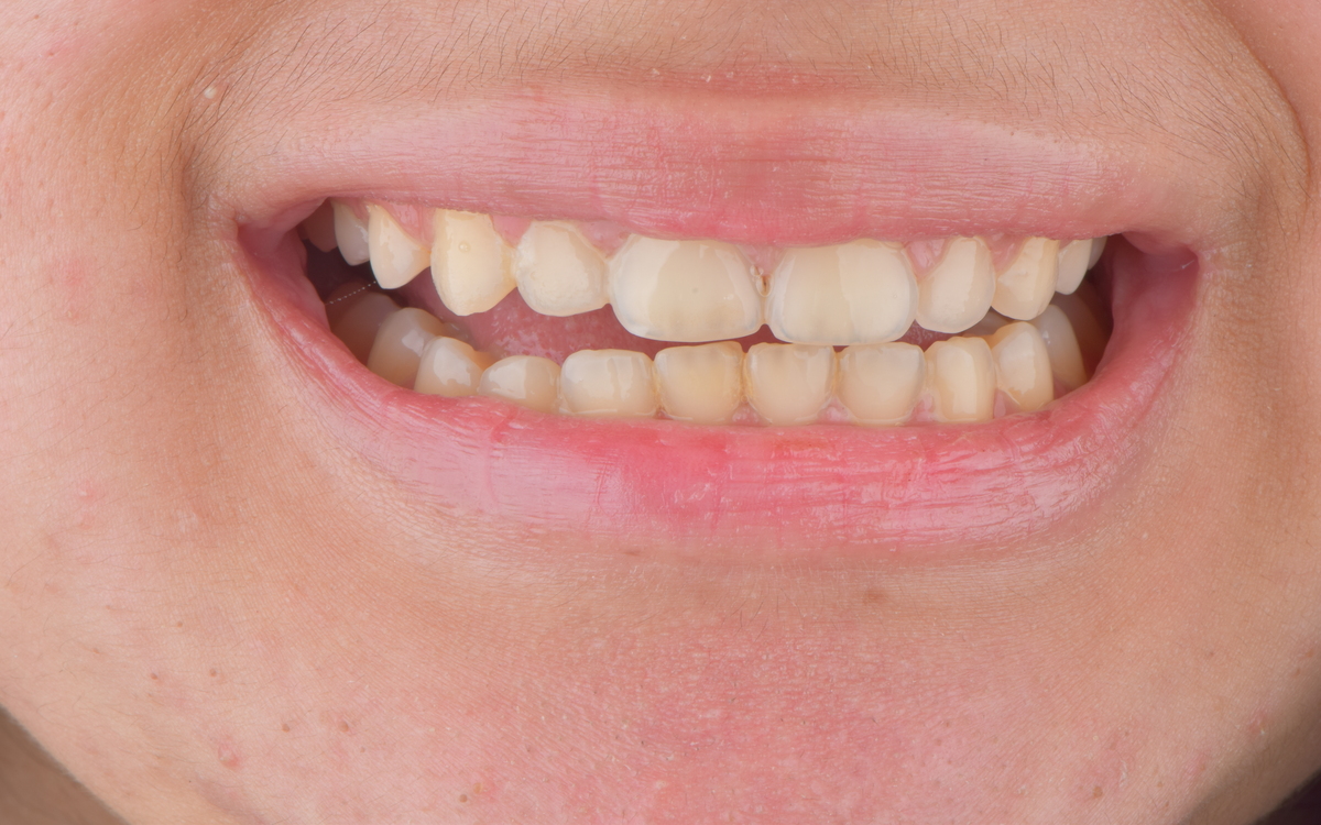 Orthodontic case after treatment