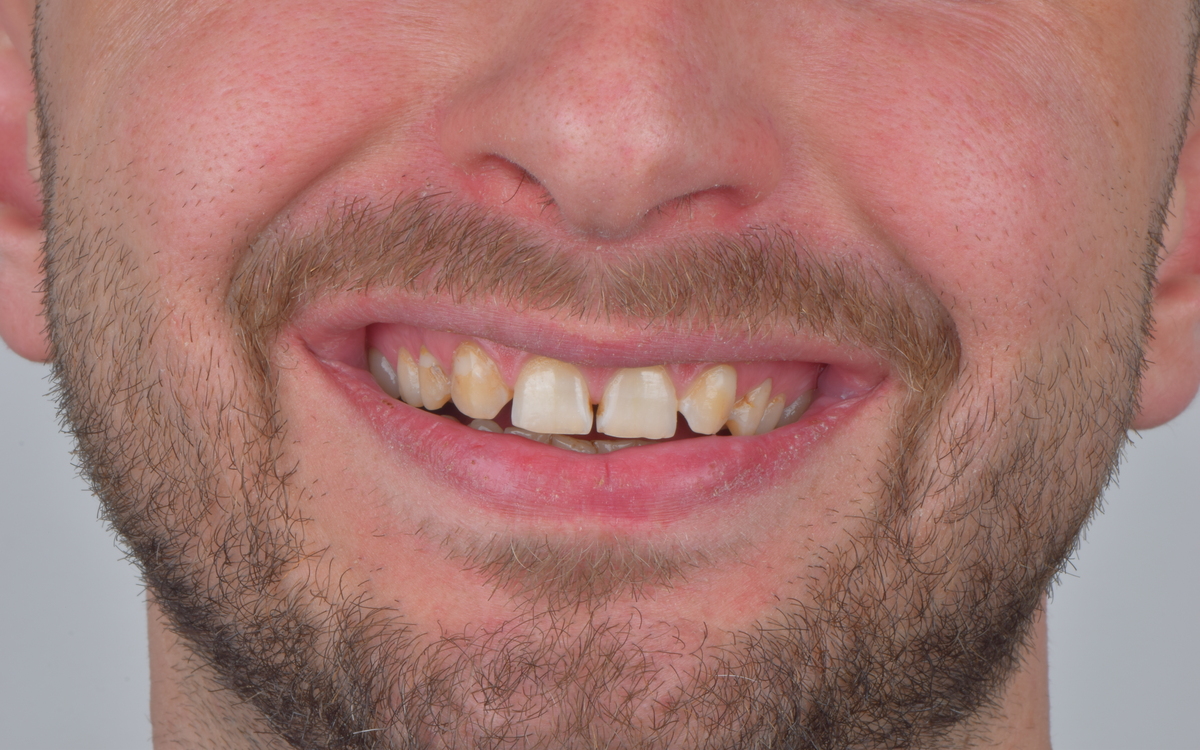 Veneers case before treatment