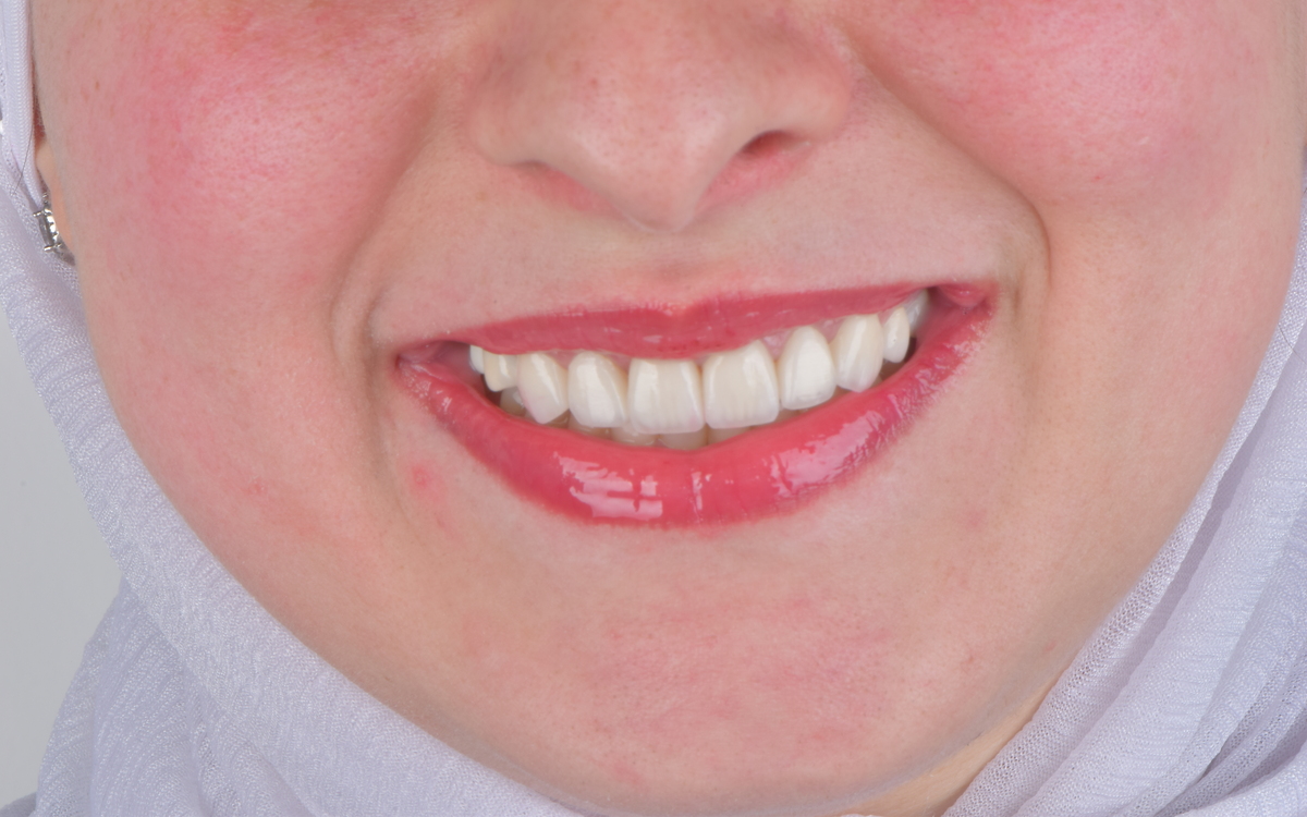 Veneers case after treatment