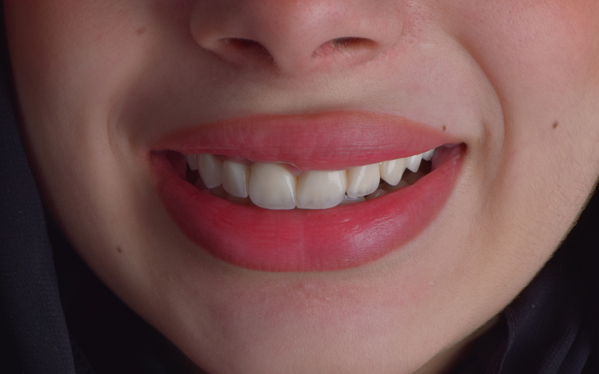 Orthodontic case after treatment