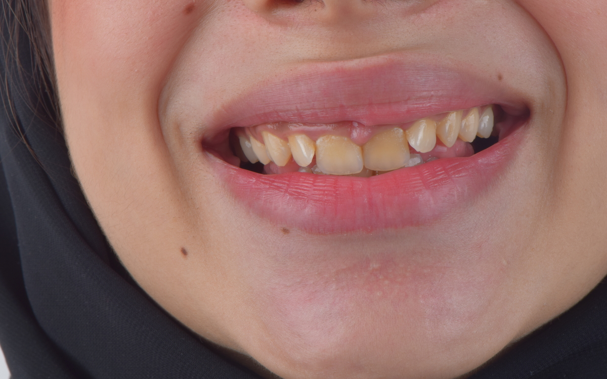 Orthodontic case before treatment
