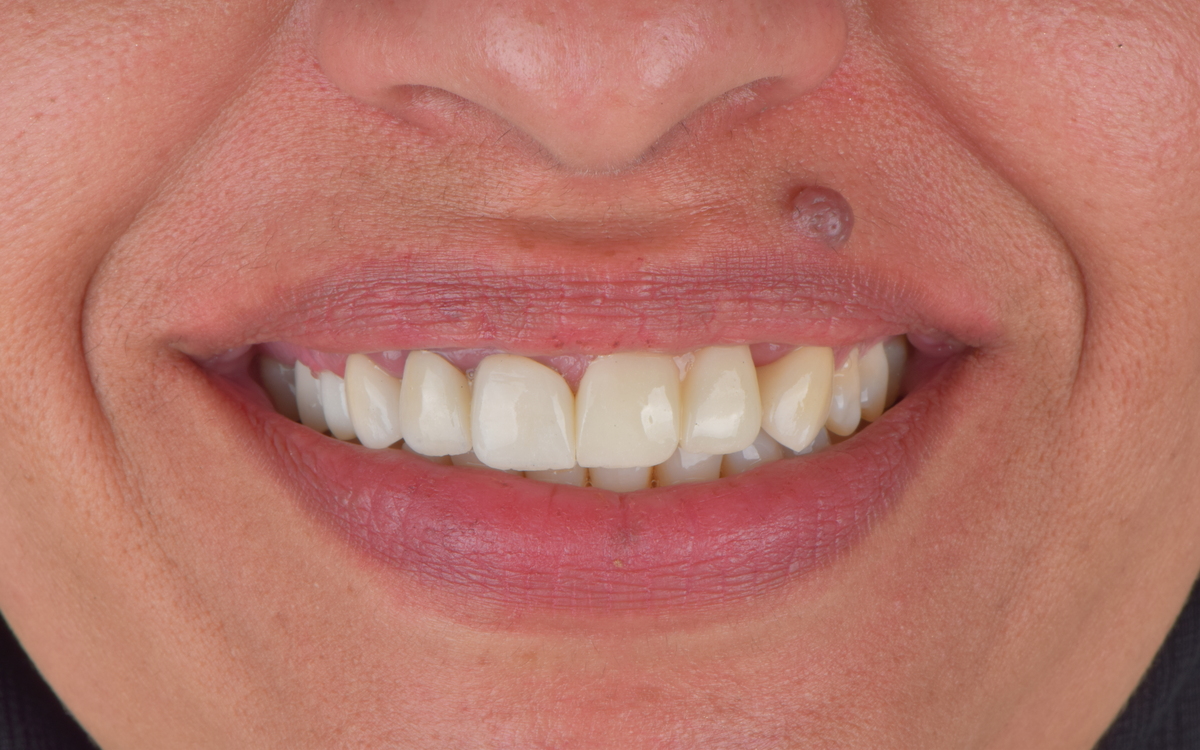 Dental implant case after treatment