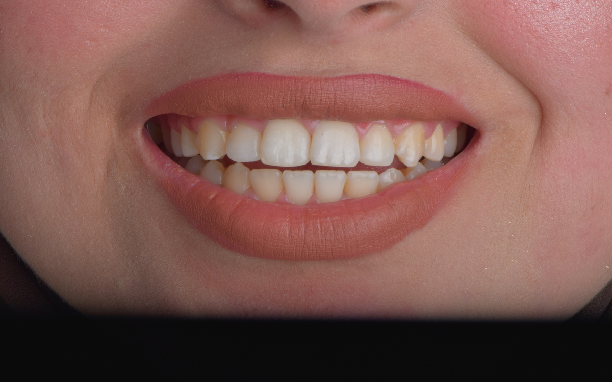 Orthodontic case after treatment