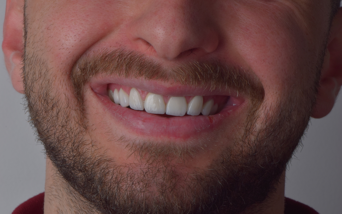 Veneers case after treatment