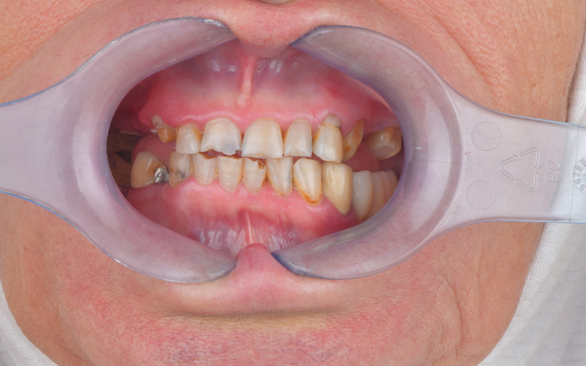 Dental implant case before treatment