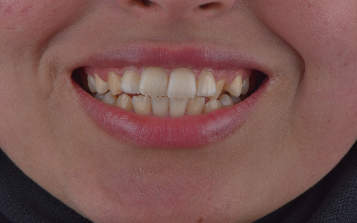 Orthodontic case before treatment