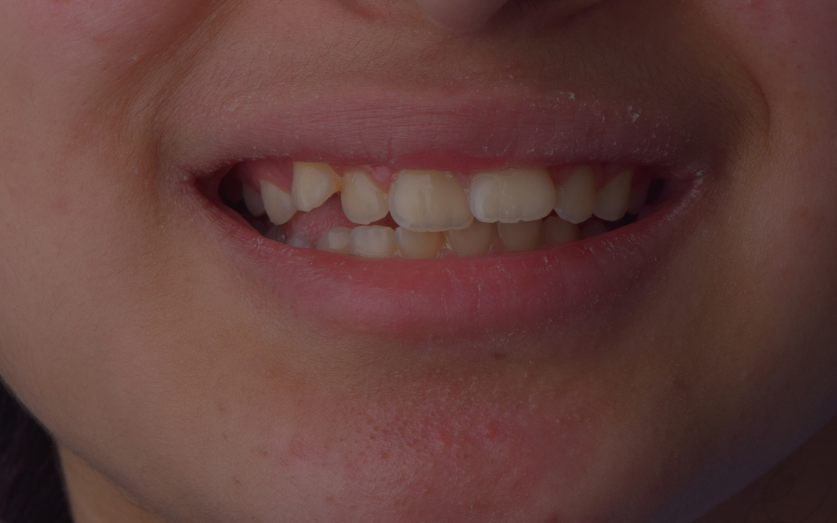 Orthodontic case before treatment