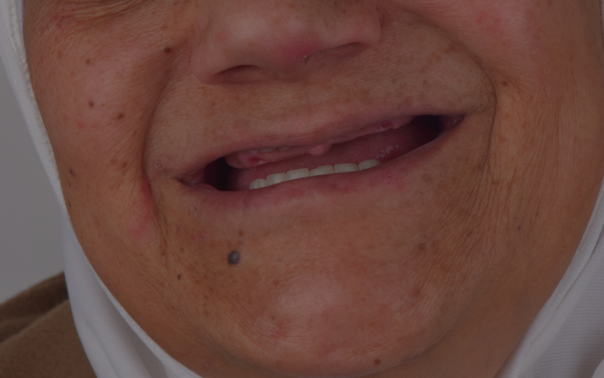 Dental implant case before treatment