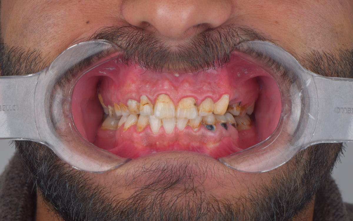 Veneers case before treatment