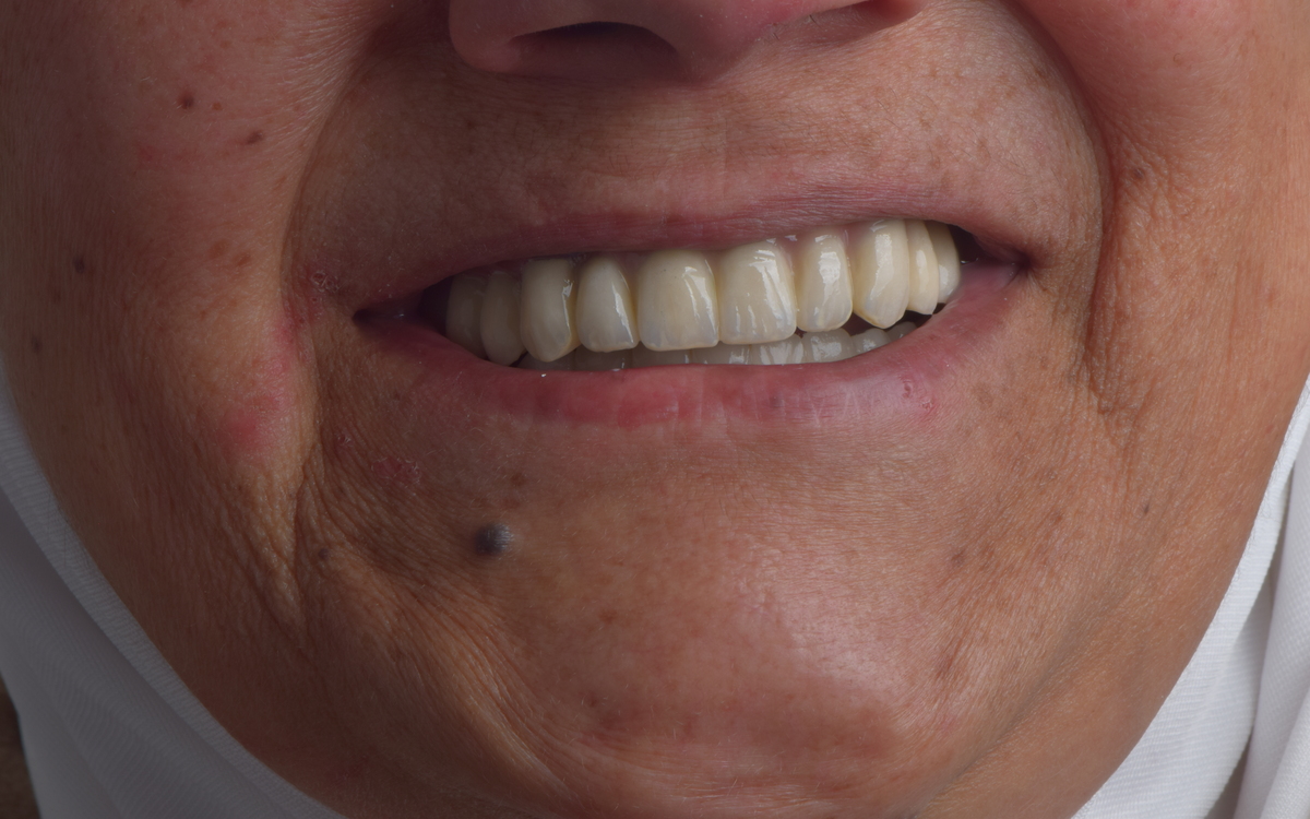 Dental implant case after treatment