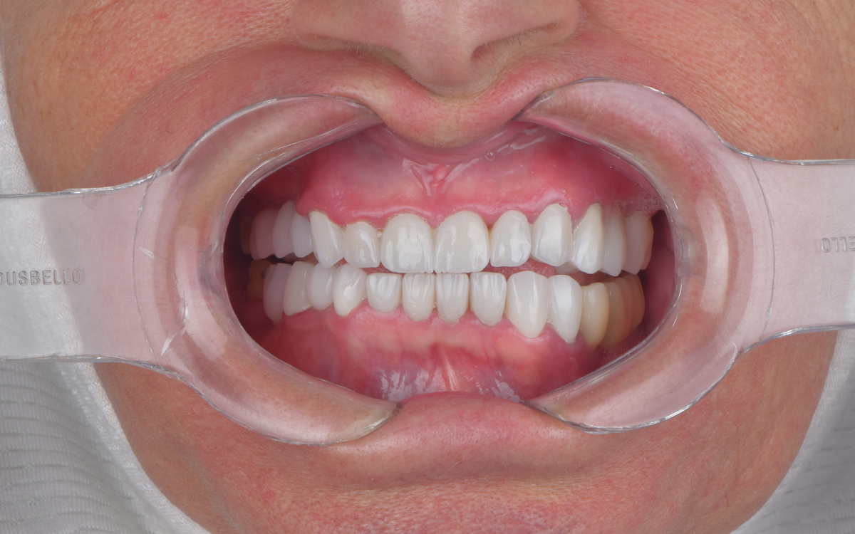 Dental implant case after treatment