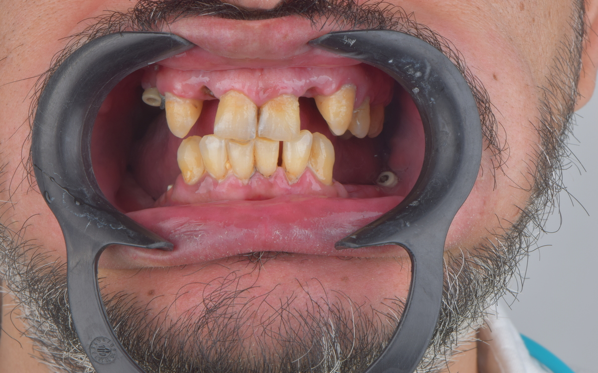 Dental implant case before treatment