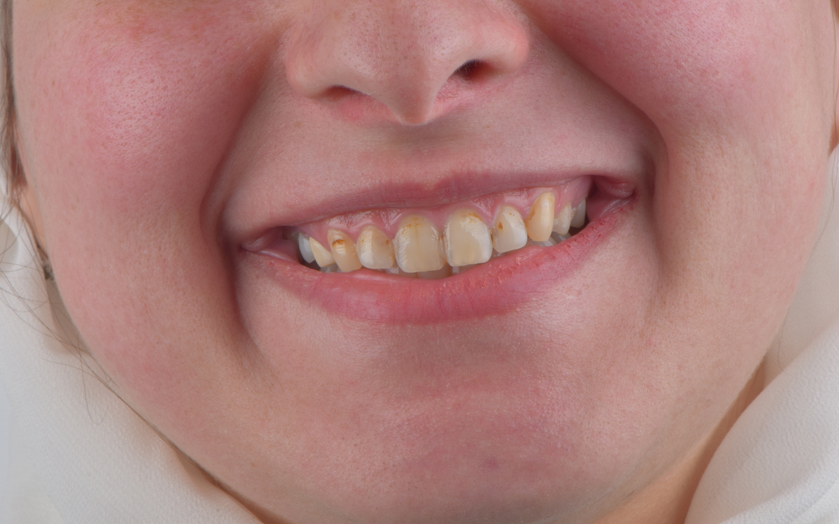 Veneers case before treatment