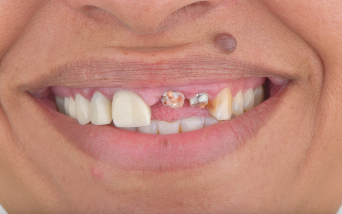 Dental implant case before treatment