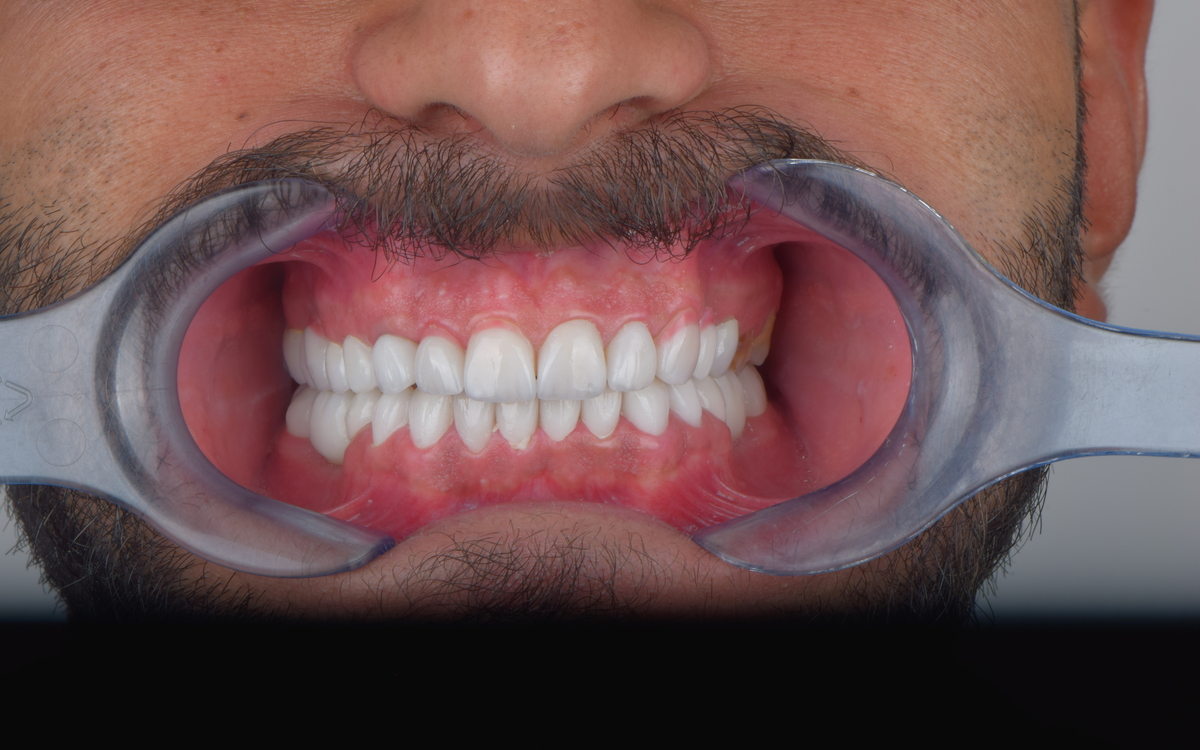 Veneers case after treatment