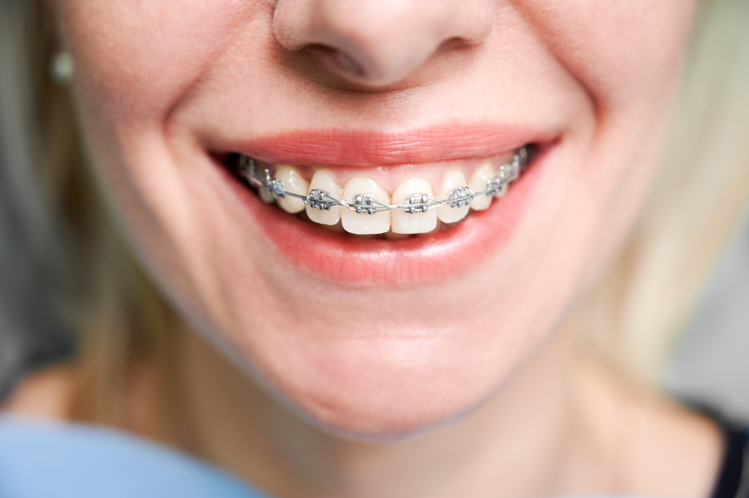 Orthodontic braces treatment at Dr. Hamarneh Dental Center