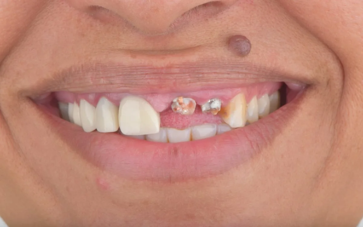 Broken and damaged front teeth before emergency dental treatment at a clinic in Khalda