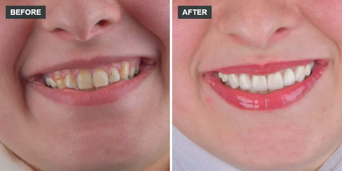 Real veneers case before and after treatment by a dentist in Khalda, Amman