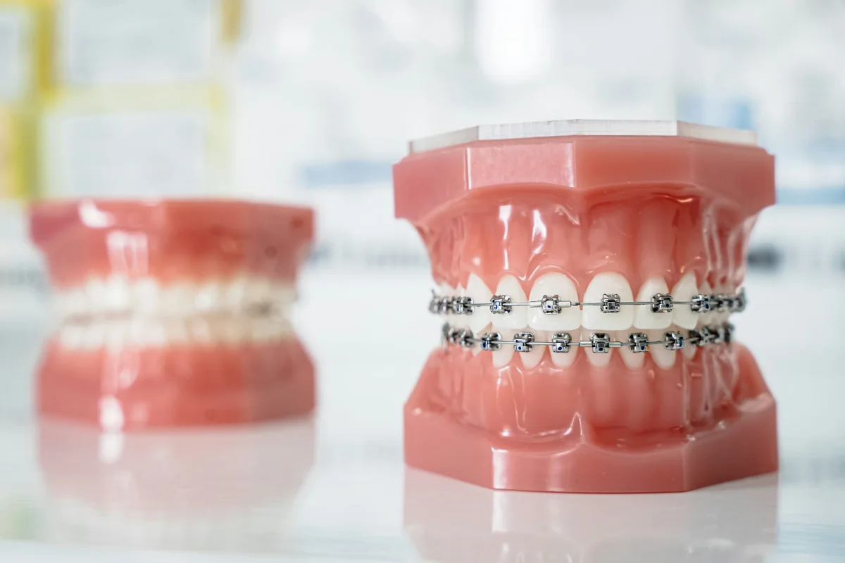 Dental models showing fixed braces used to explain types of braces to patients in Khalda