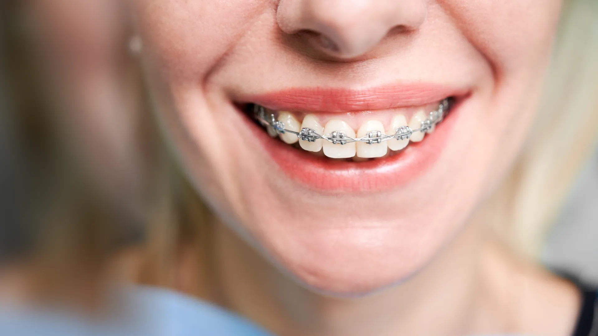Types of braces: smiling patient with fixed braces at an orthodontist in Amman